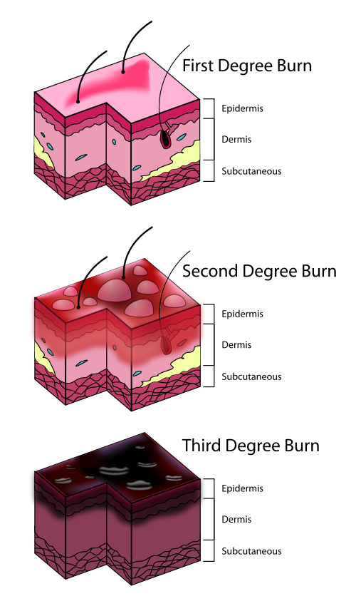 What is the first aid treatment for first degree burns?