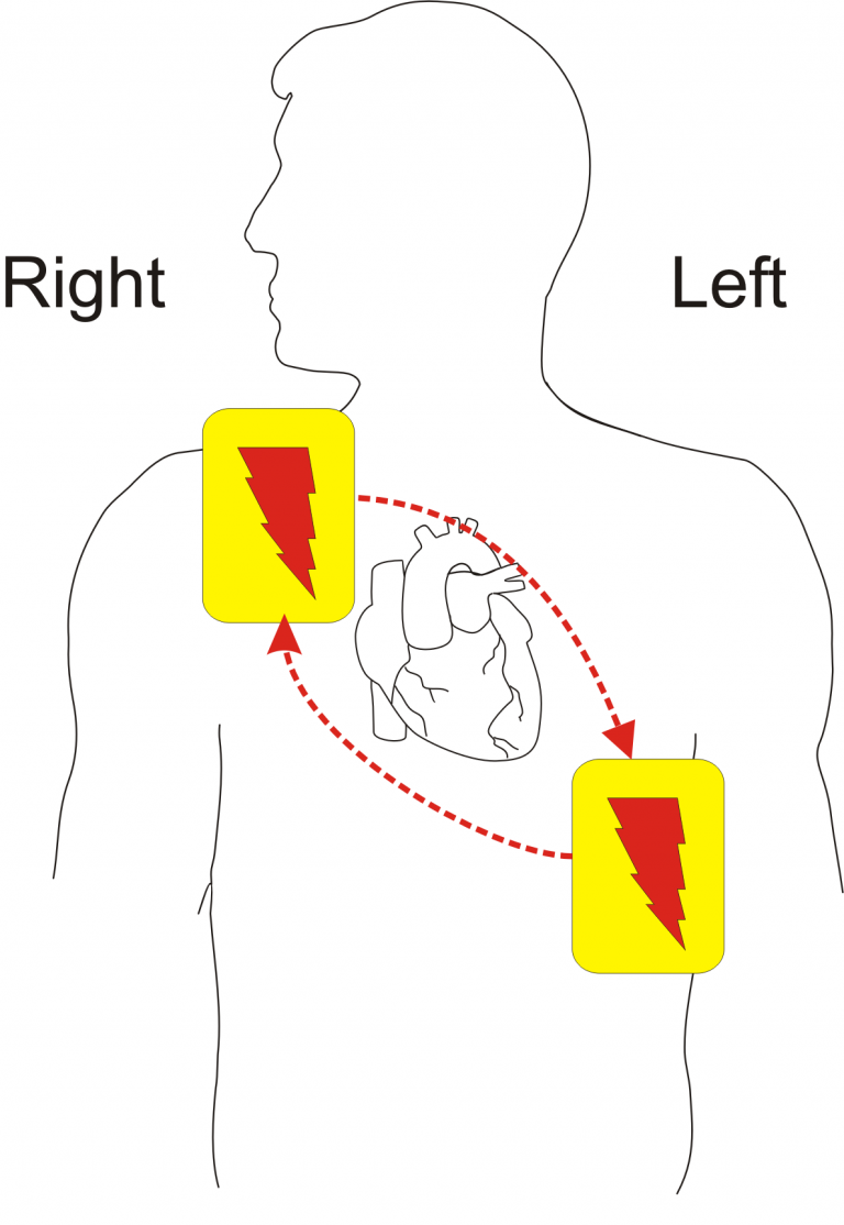 Defib_electrode_placement Online CPR & FirstAid Certification Courses