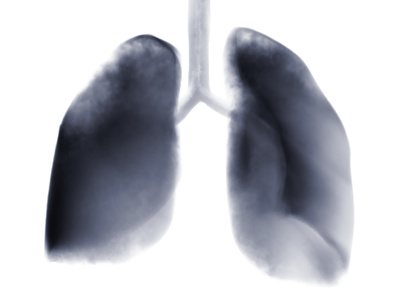 What is Lung Cancer? Signs, Symptoms, Treatment, Prevention