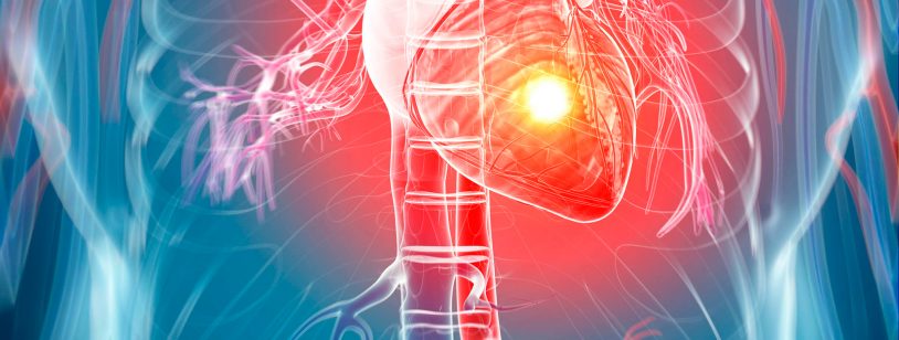heart attack, heart attack treatment, heart attack treatmens, heart attack symptoms, symptoms, treatment